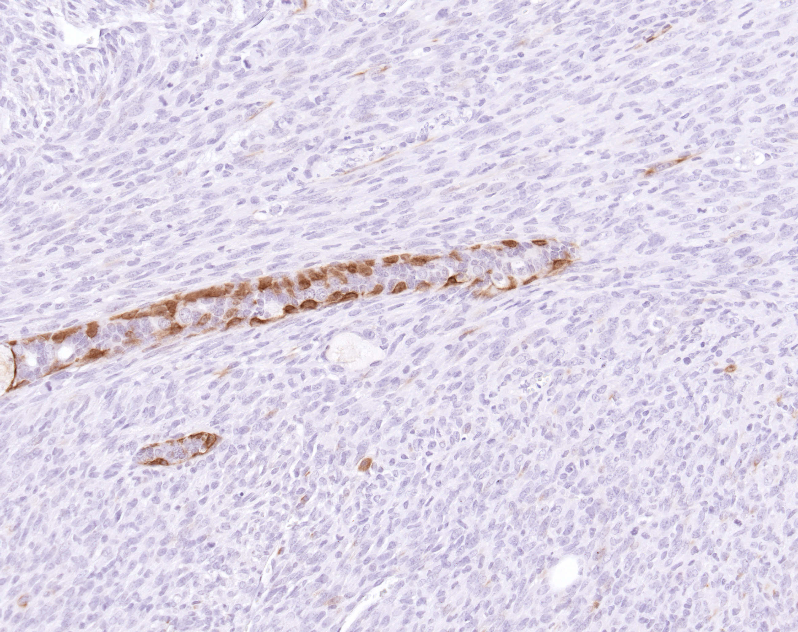 Epithelial to Mesenchymal (EMT) tumor with vestiges of CK14+ve epithelial tumor cells